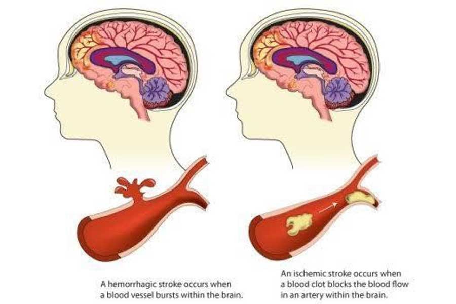 Treatment and prevention of stroke through awareness