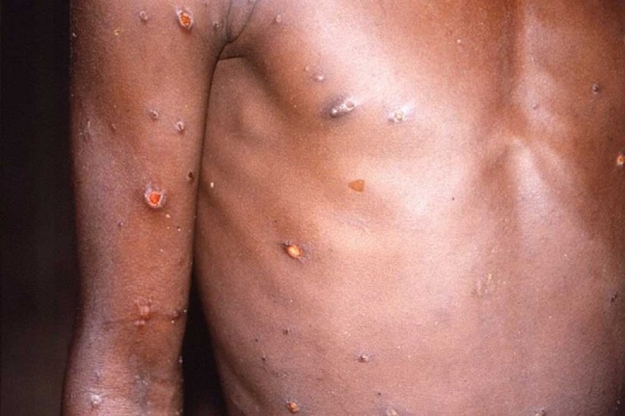 What is monkeypox and where is it spreading?