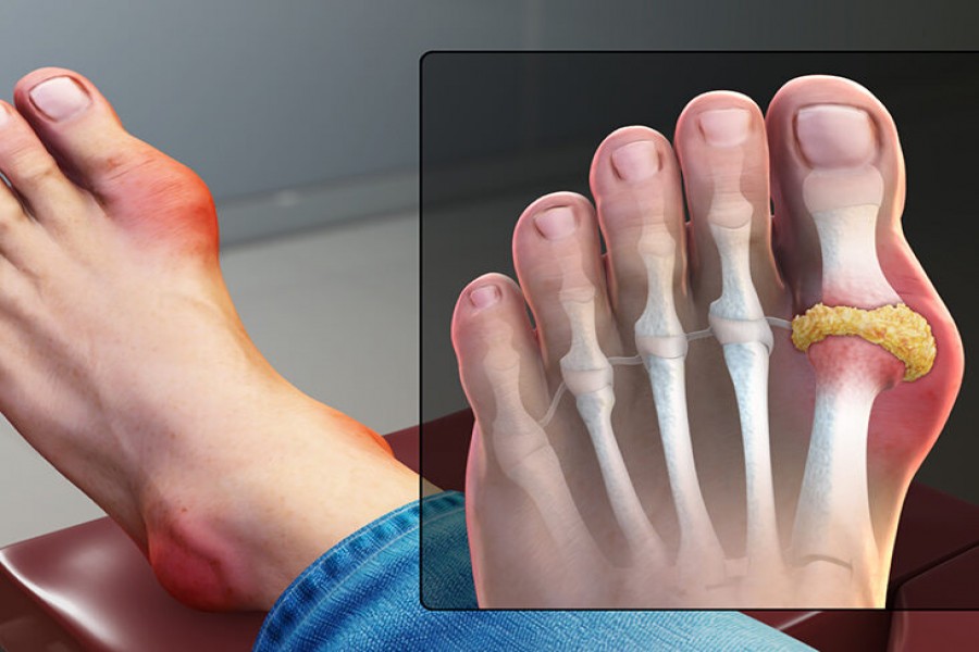 The pain of gout: A disease that never goes away