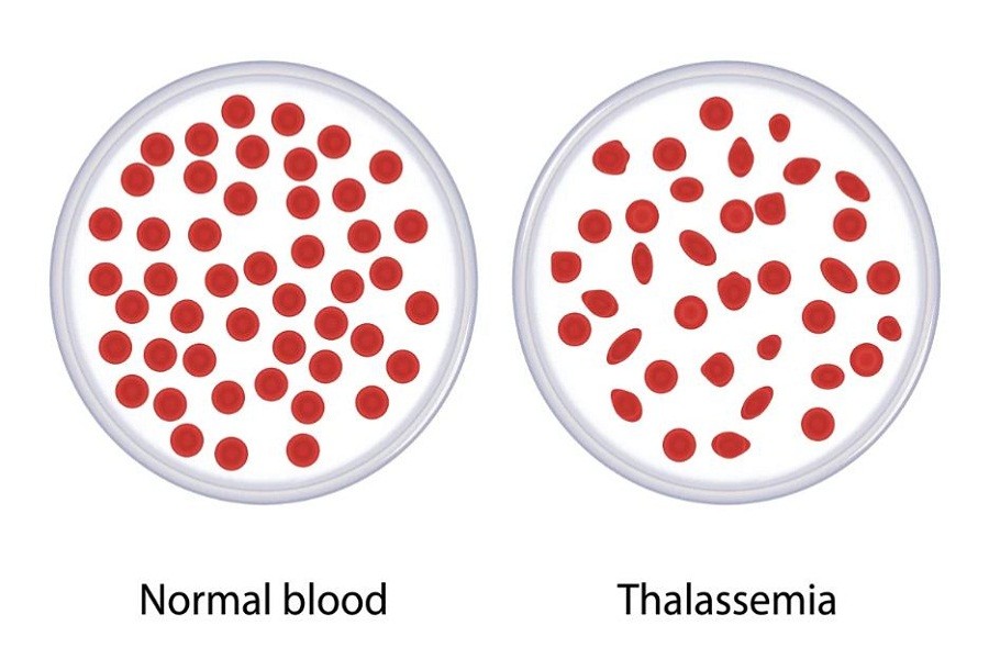 How the government can decrease thalassemia deaths effectively