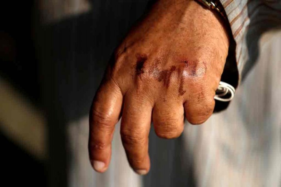 A man's hand is seen after washing off the home quarantine stamp during a nationwide lockdown to slow the spreading of the coronavirus disease (COVID-19) on a street in Dharavi, one of Asia's largest slums, Mumbai, India, Apr 11, 2020. REUTERS