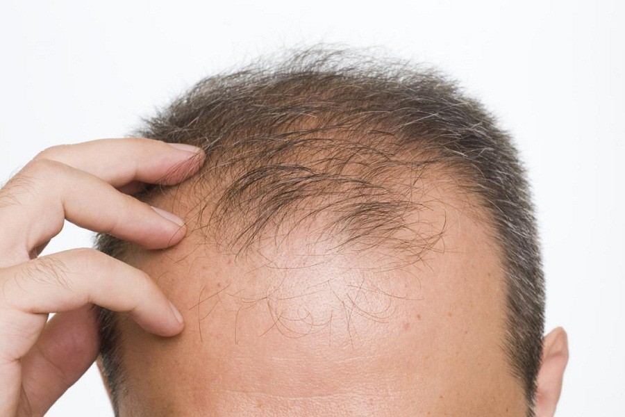 Vitamin E for hair loss treatment: Fact or myth?