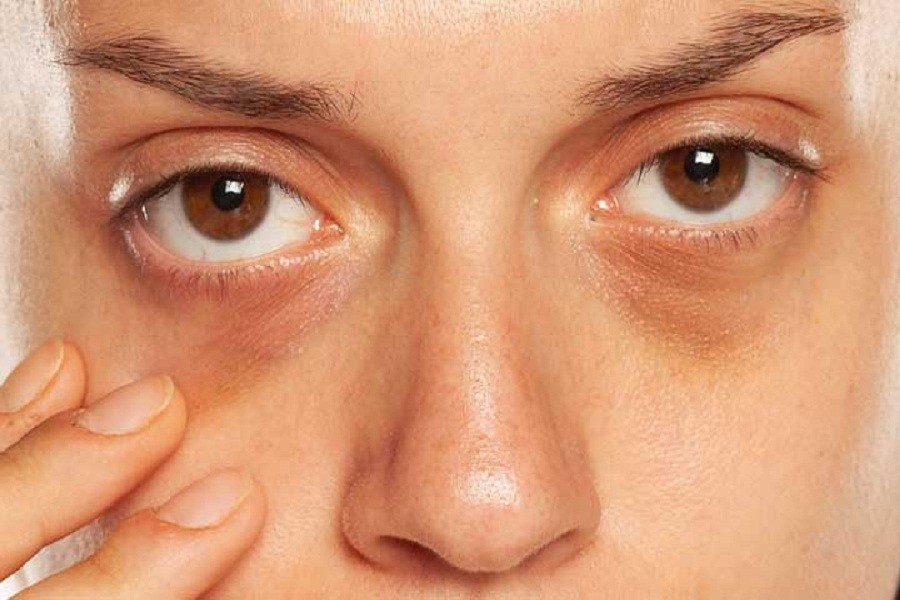 Preventing dark circles is easy